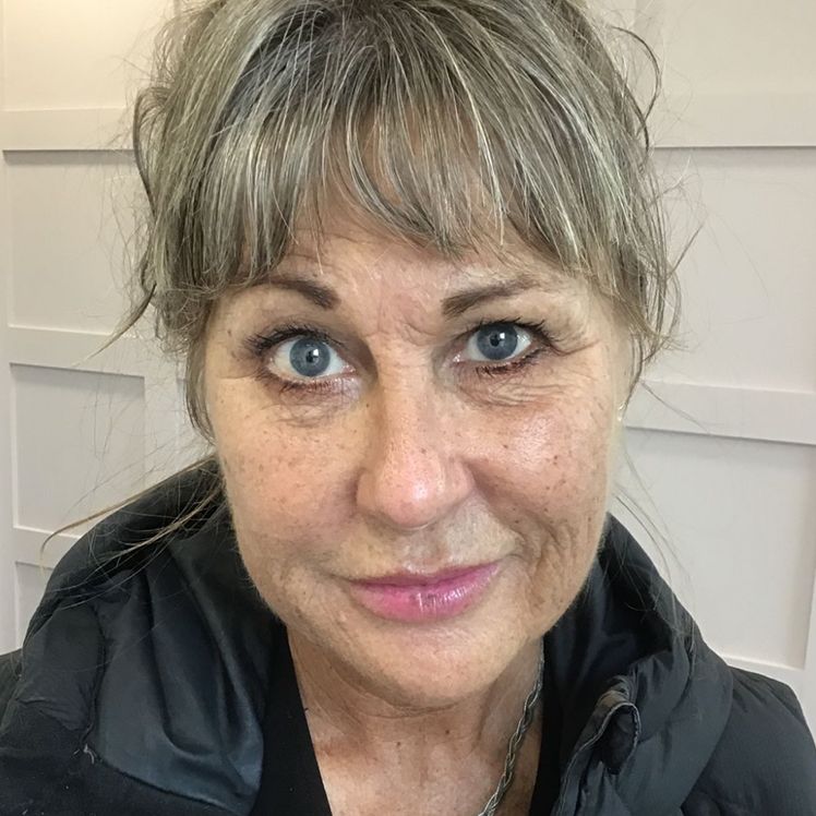 Sharon before dermatica anti-ageing treatment