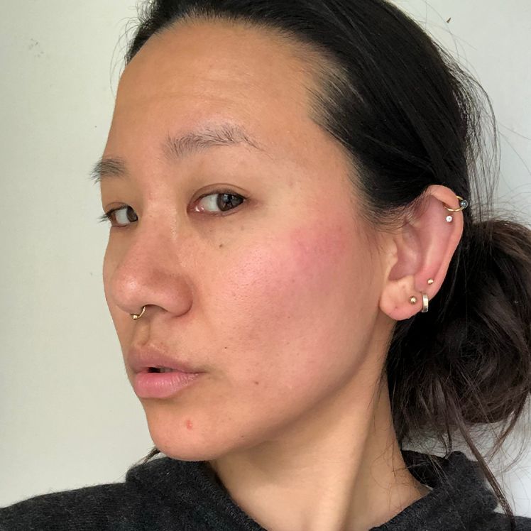 Sakiko after dermatica acne treatment