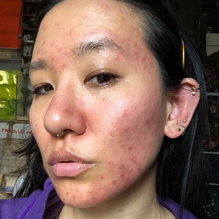 Sakiko before dermatica acne treatment