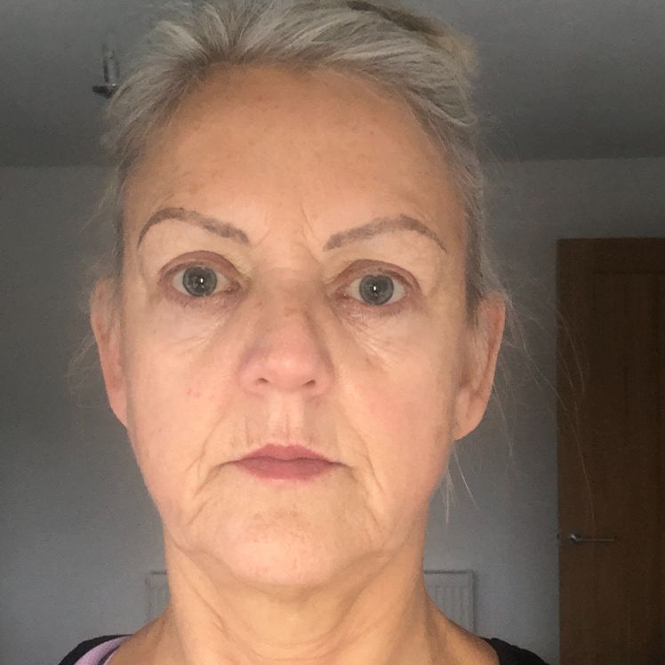 Vanessa after dermatica anti-ageing treatment