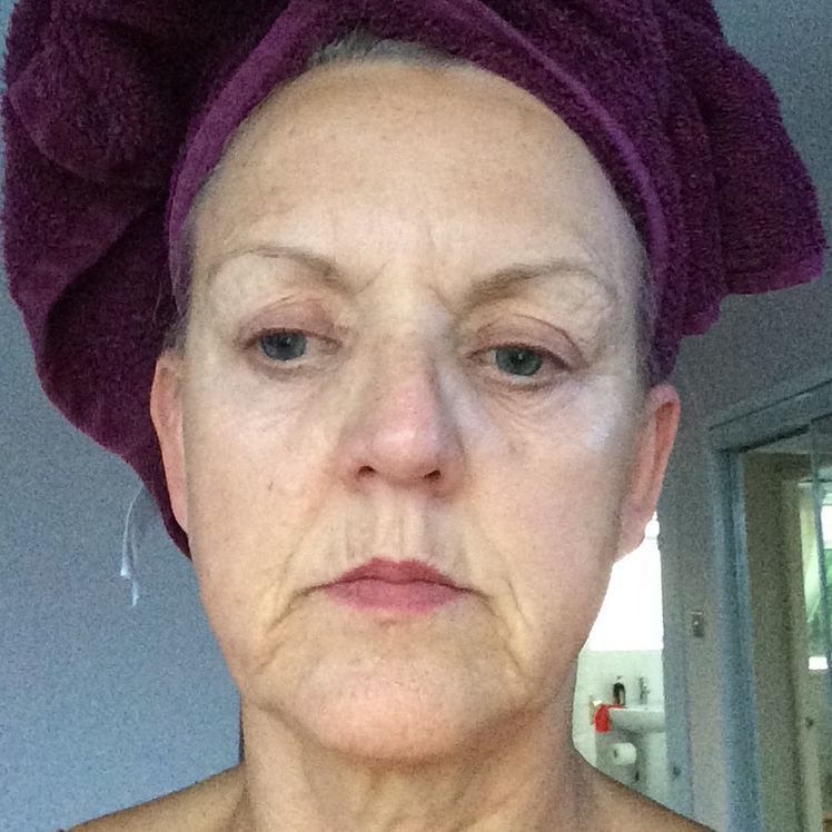 Vanessa before dermatica anti-ageing treatment