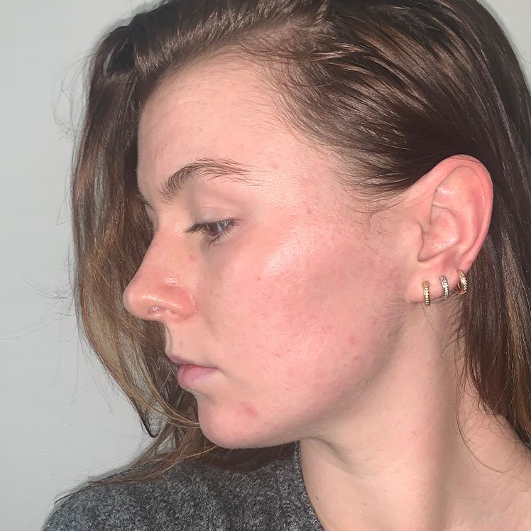 Molly after dermatica acne treatment