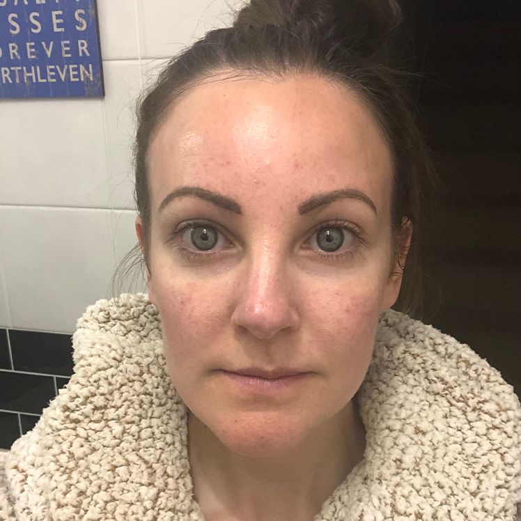 Lucy after dermatica rosacea treatment