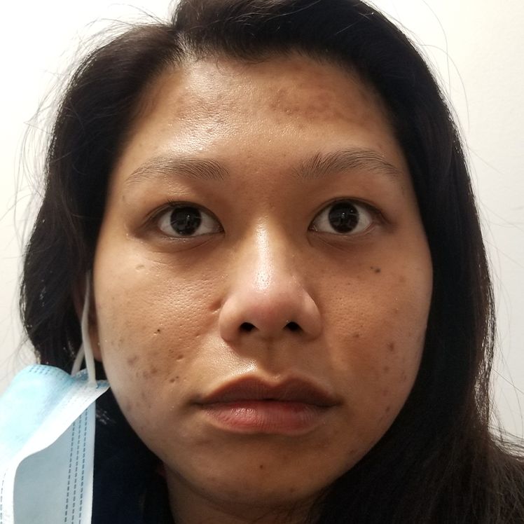 Ruth after dermatica acne treatment