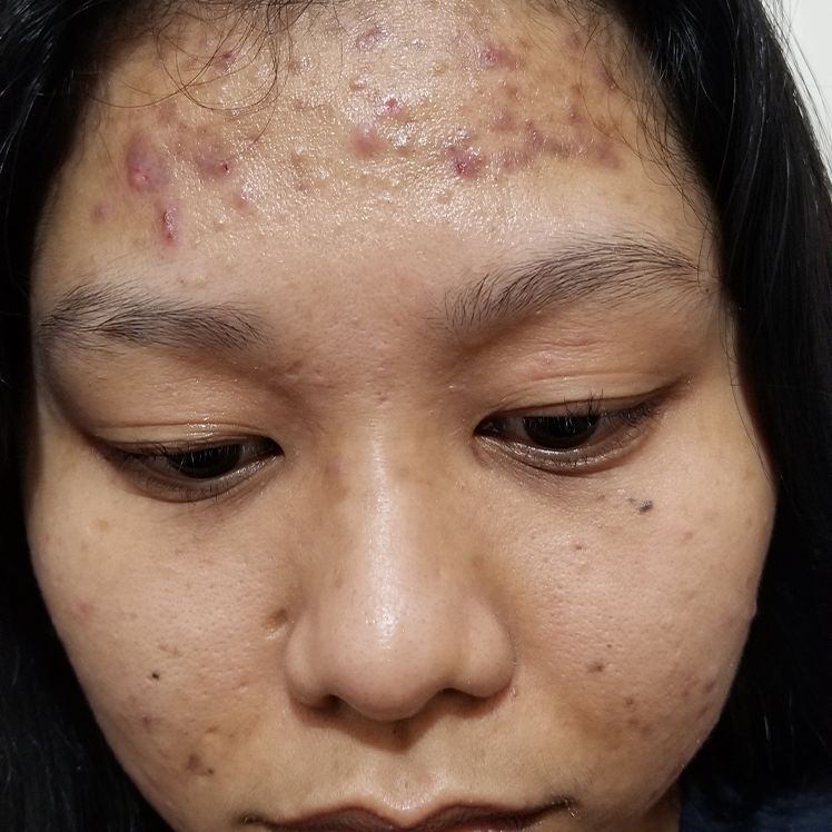 Ruth before dermatica acne treatment