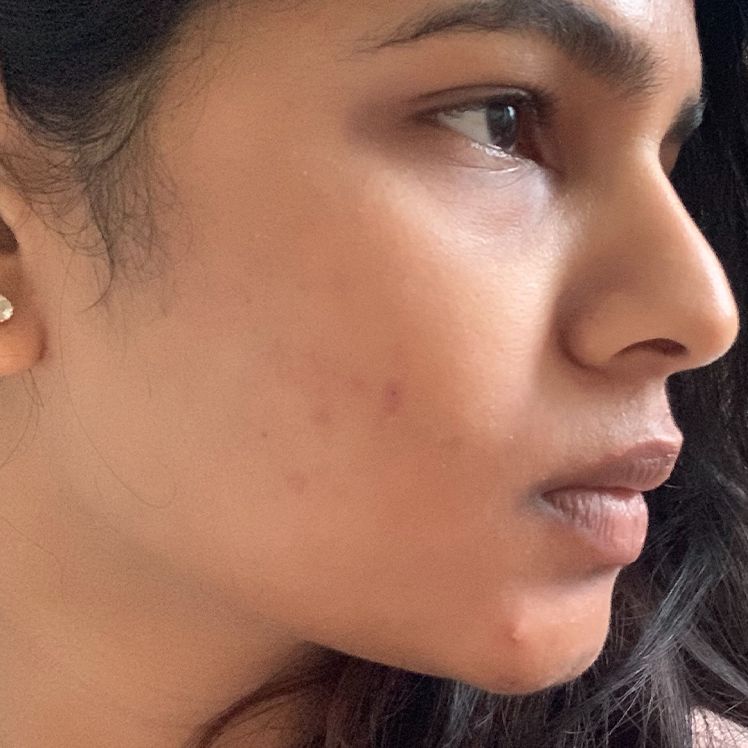 Haneela after dermatica acne treatment