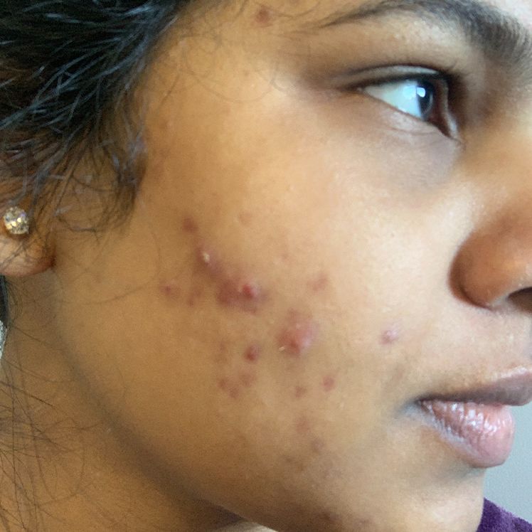 Haneela before dermatica acne treatment