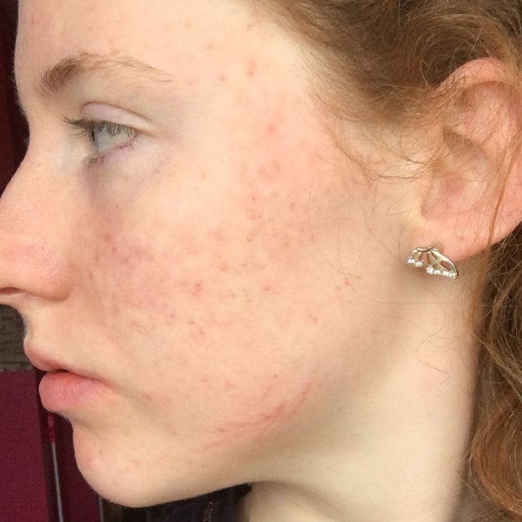 Aideen after dermatica acne treatment