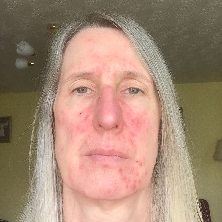 Karen before dermatica acne treatment
