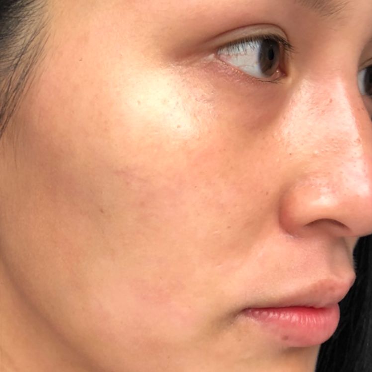Lily after dermatica anti-ageing treatment