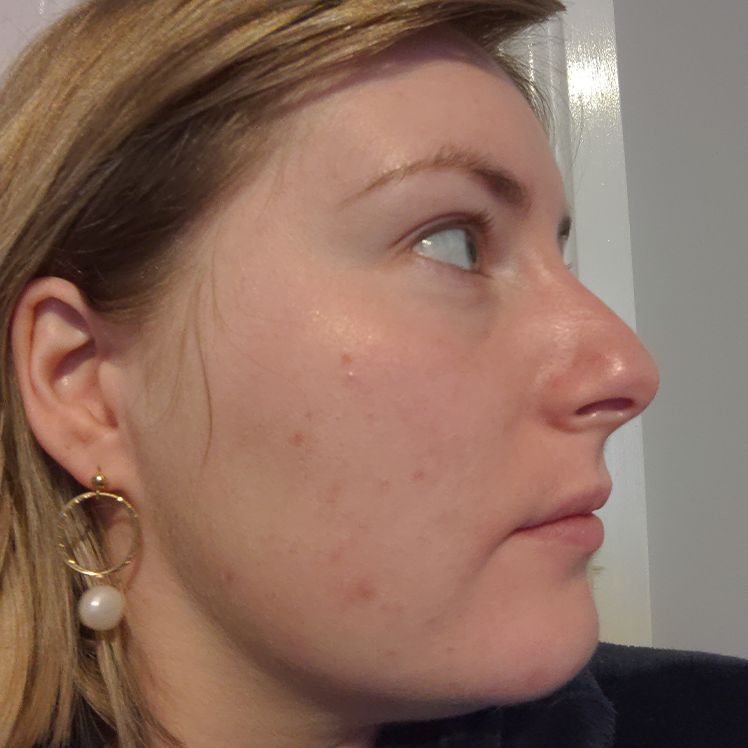 Victoria after dermatica acne treatment