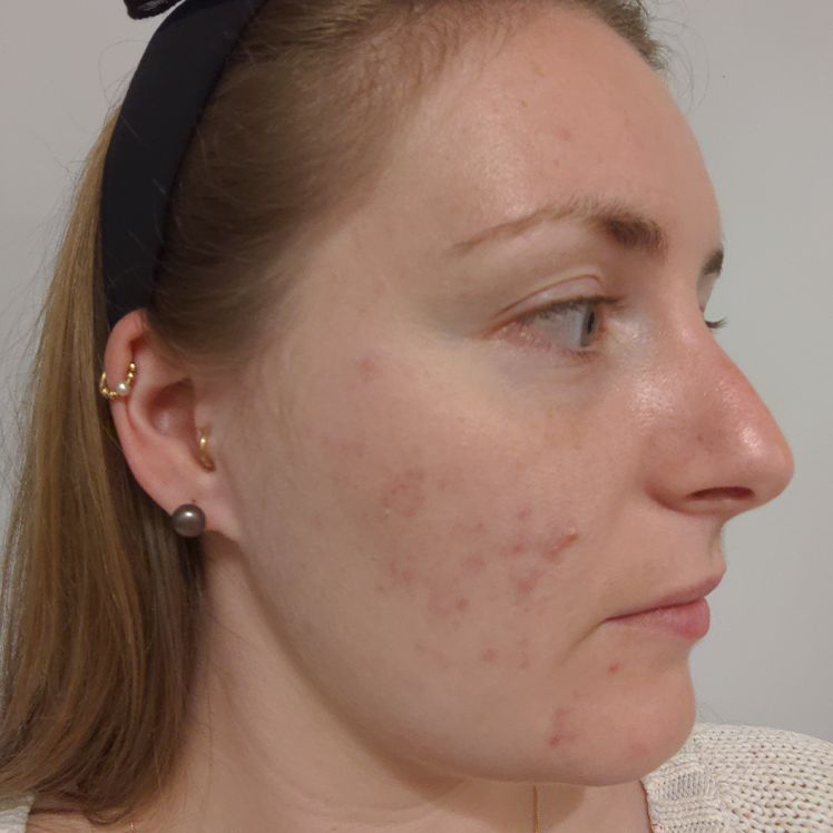 Victoria before dermatica acne treatment