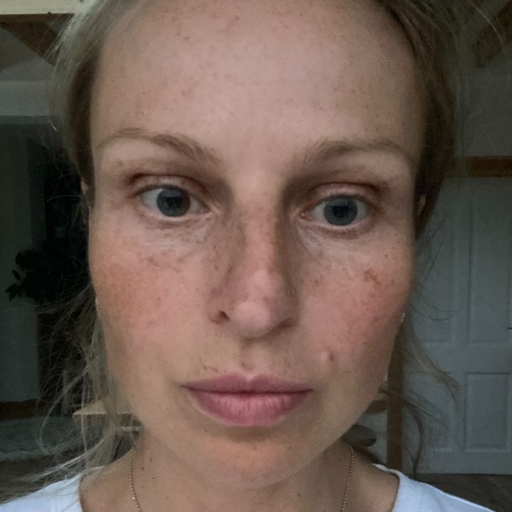 Magdalena before dermatica hyperpigmentation treatment