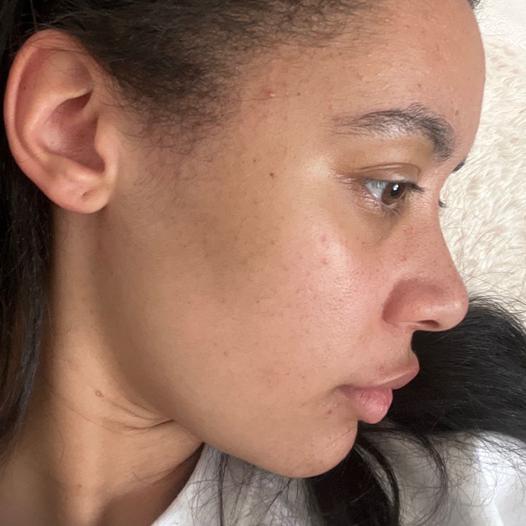 Maia after dermatica acne treatment