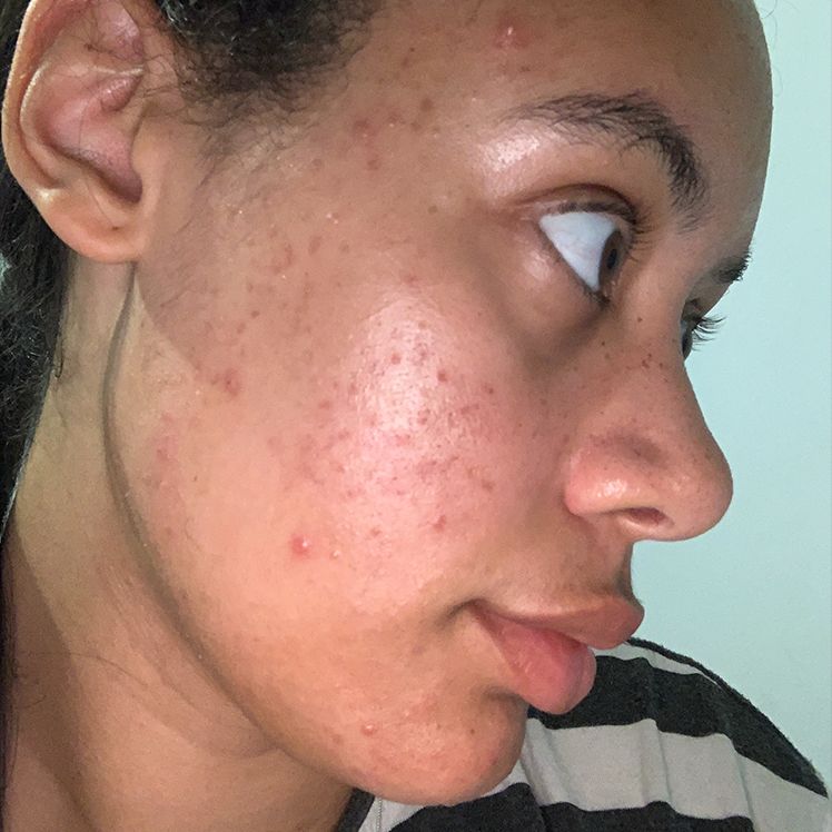 Maia before dermatica acne treatment