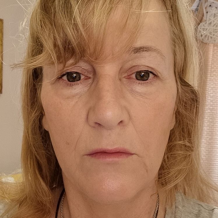 Debra before dermatica anti-ageing treatment