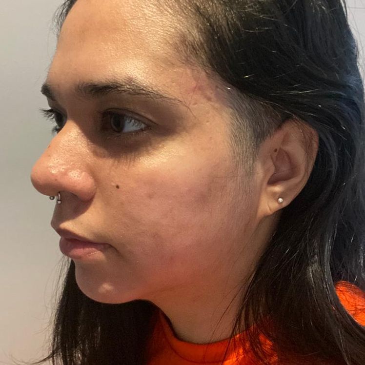 Rhaiane after dermatica acne treatment
