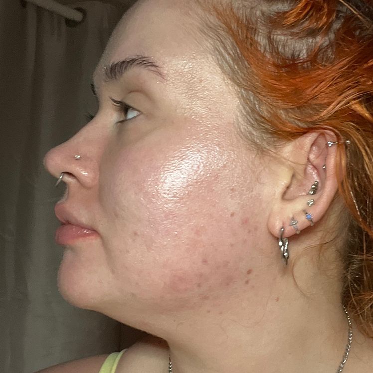 Emily after dermatica acne treatment