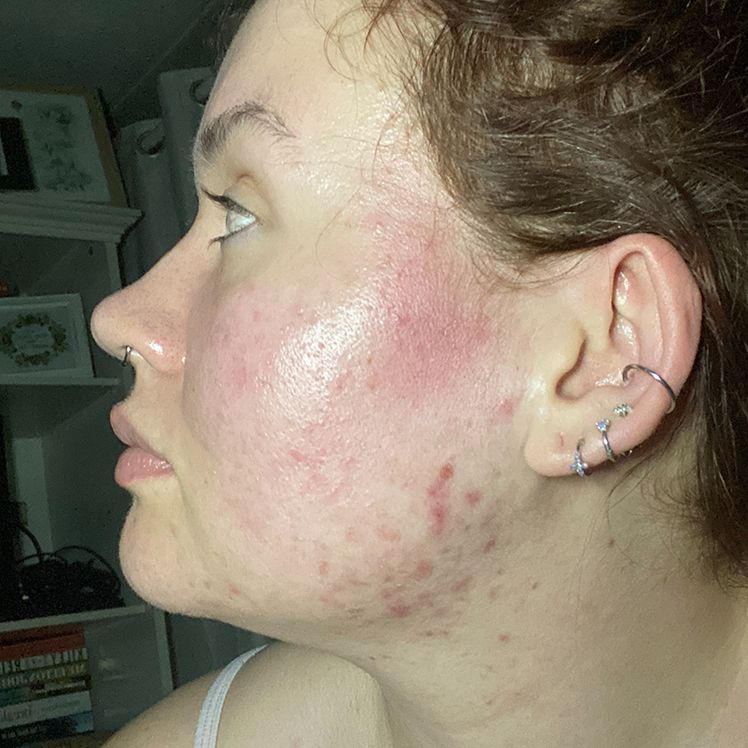 Emily before dermatica acne treatment