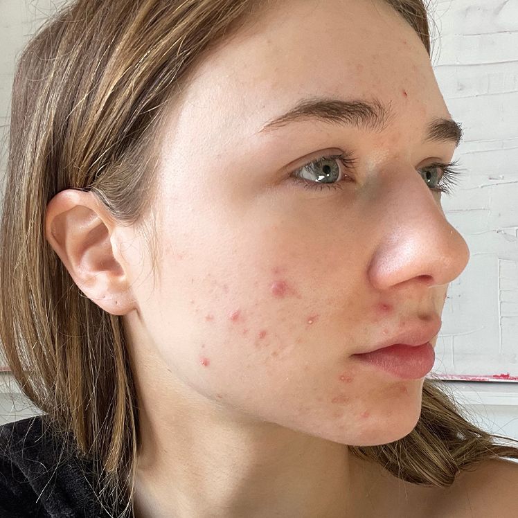 Ella before dermatica acne treatment