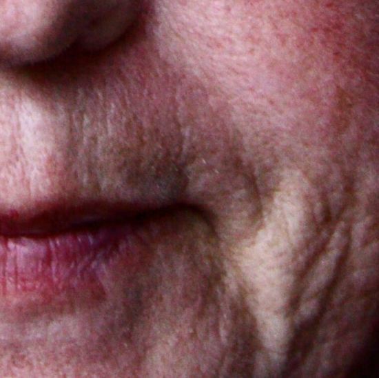 Woman with winter rosacea