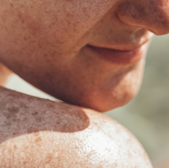 Persons shoulder and face with pigmentation