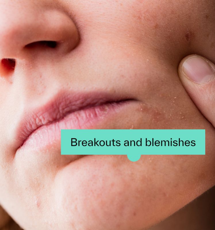Breakouts and blemishes