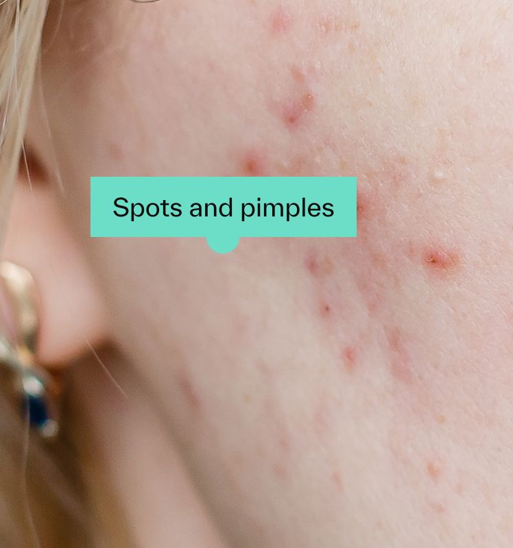 Spots and pimples