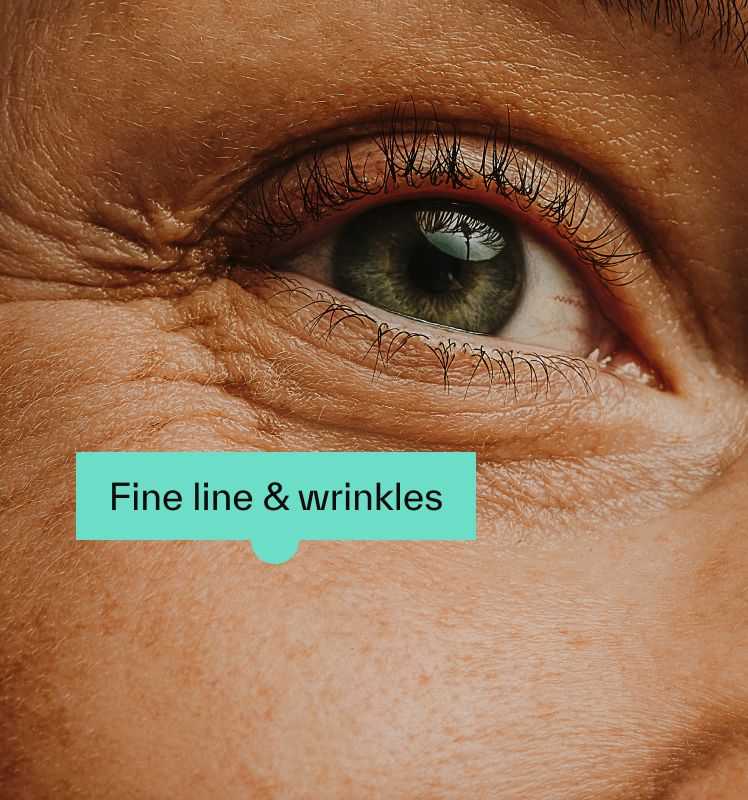 Fine line and wrinkles