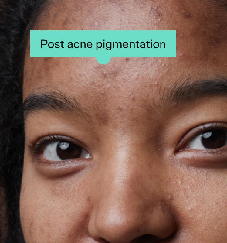 Post acne pigmentation