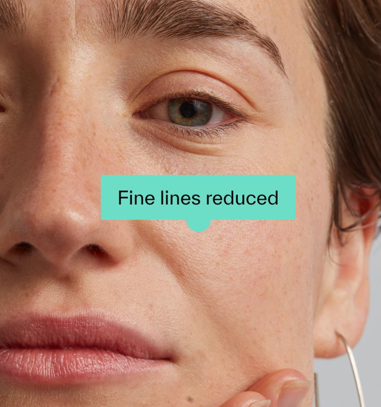 Fine lines reduced