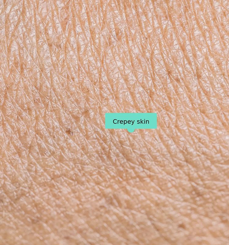 Crepey skin