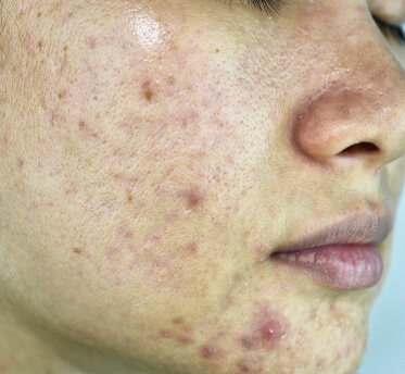 Face with hyperpigmentation