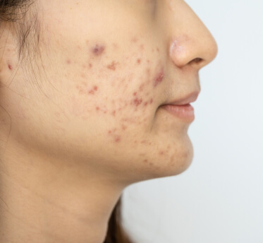 Pigmentation with acne face