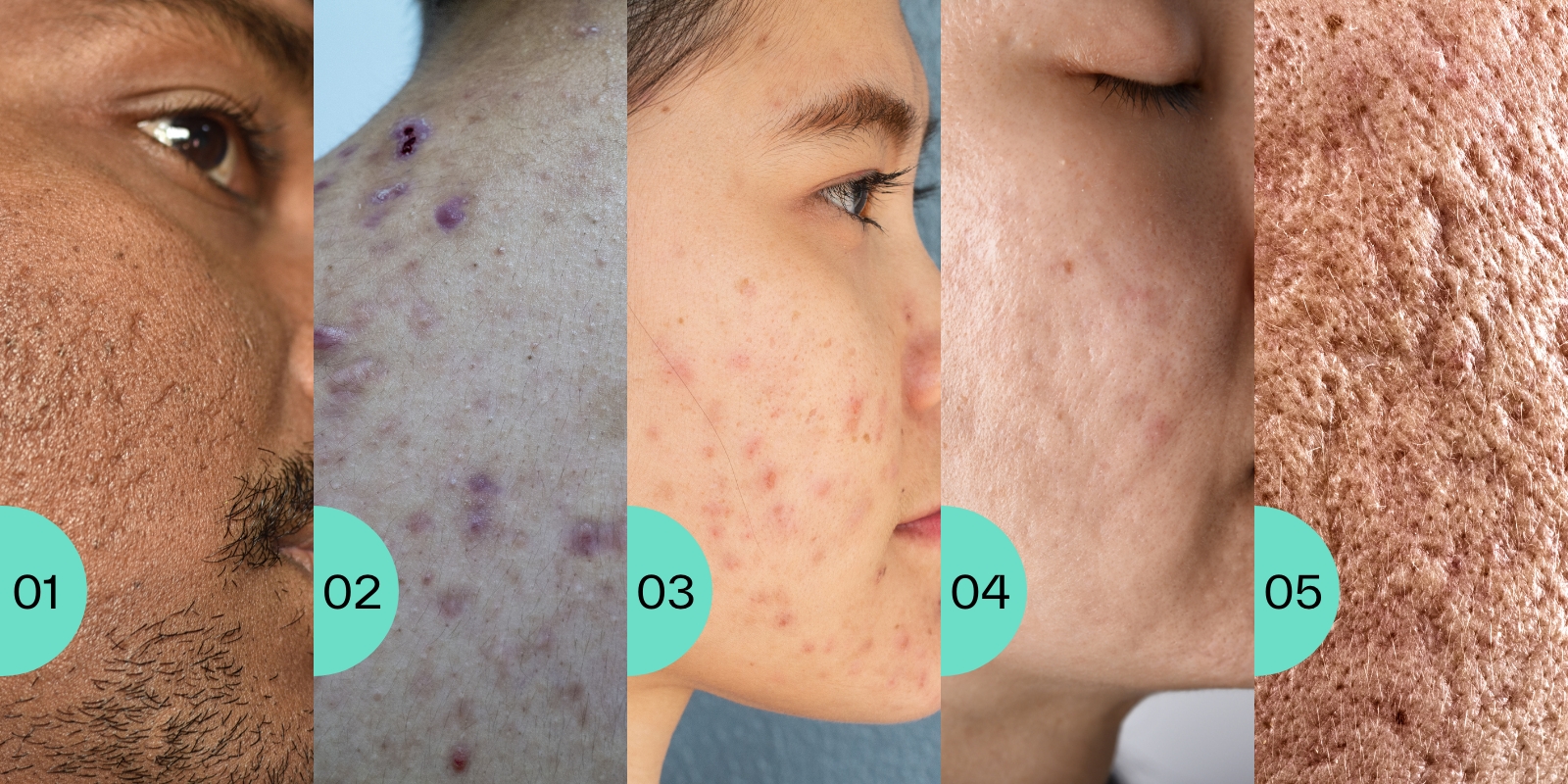 Everything You Need To Know About Acne Scarring SkinLab