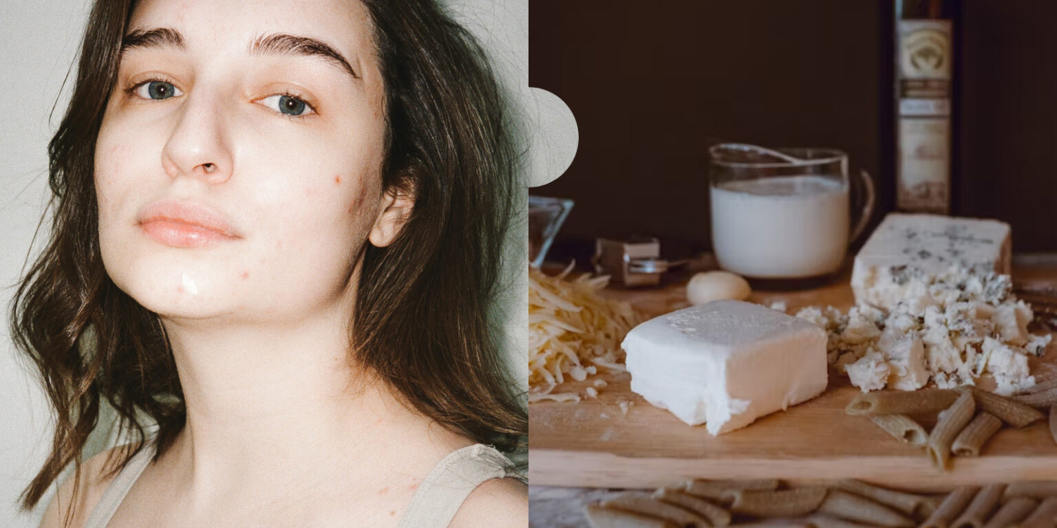 The Connection Between Diet And Acne - SkinLab