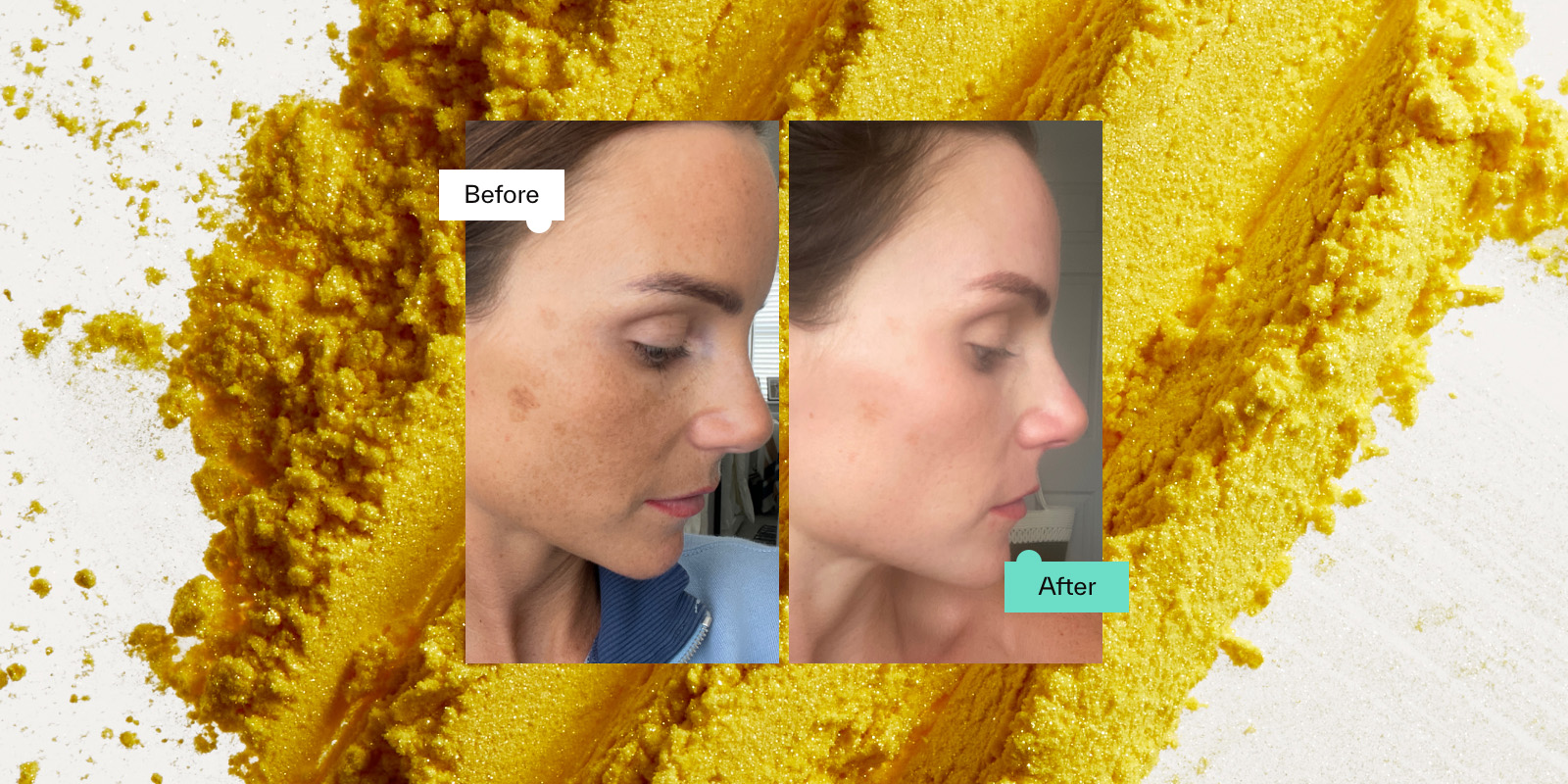 Tretinoin Before and After