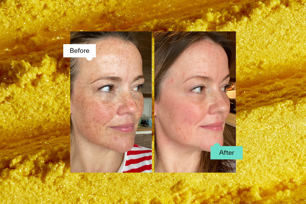 Retinol Before And After