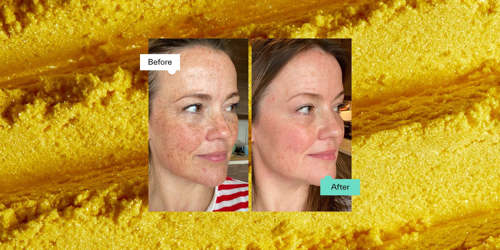 Retinol Before And After