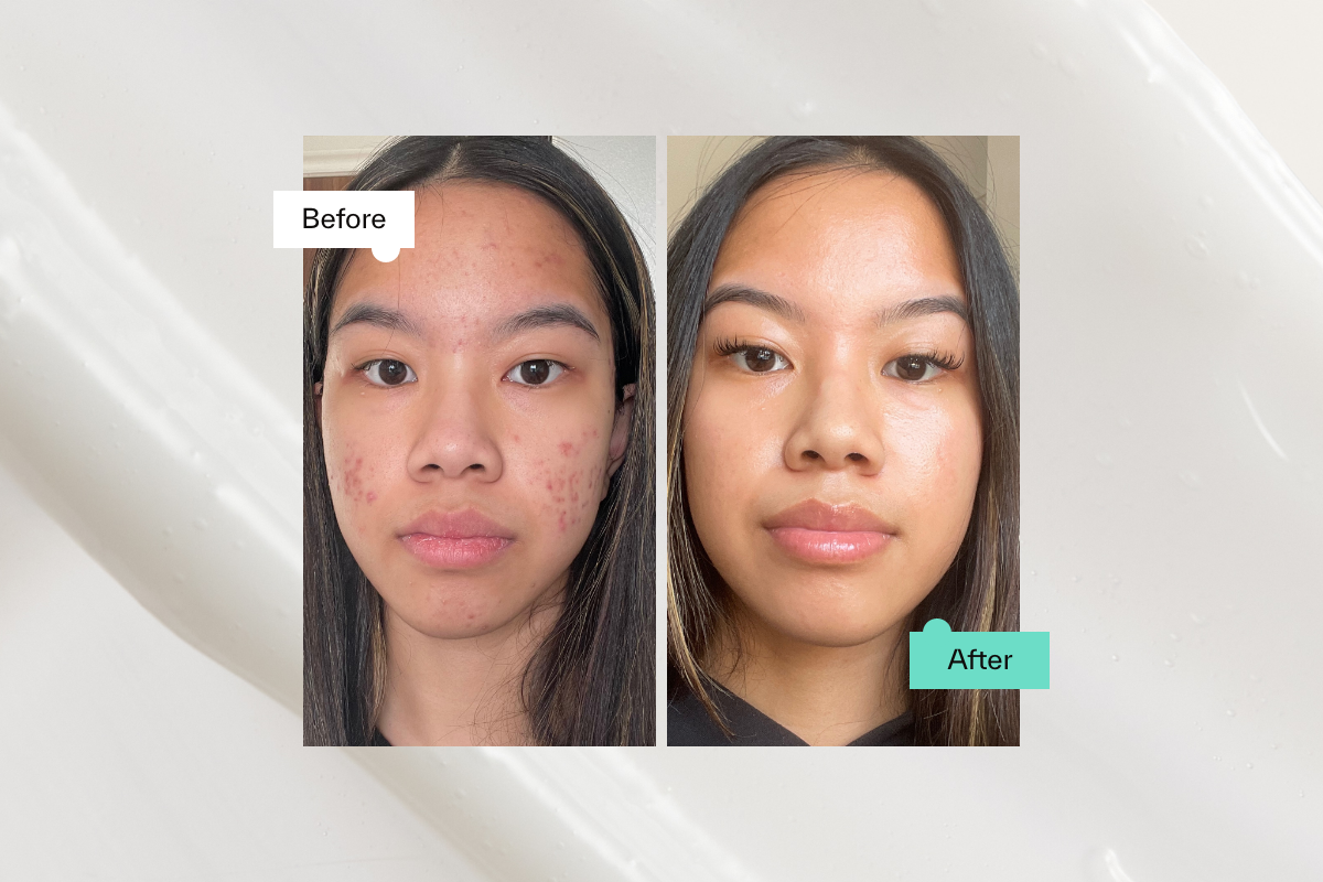 Benzoyl peroxide before and after
