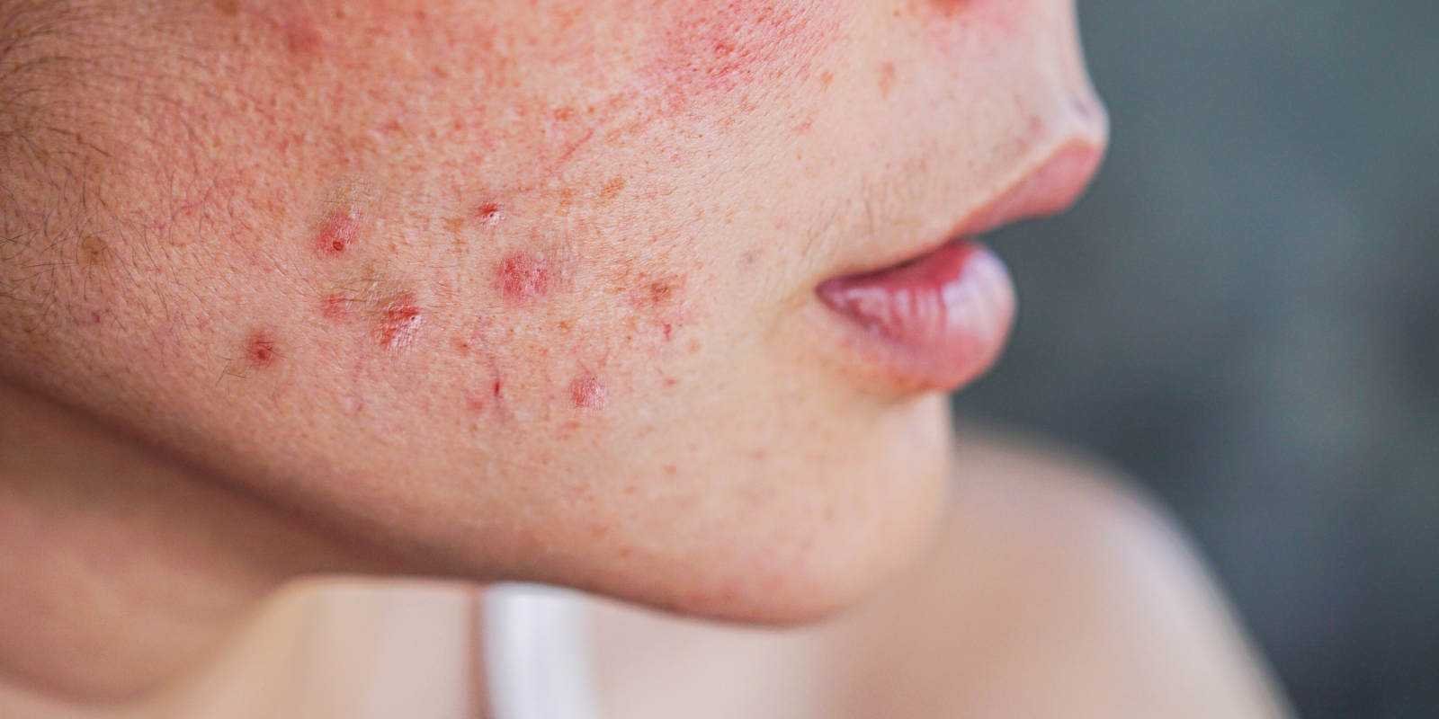 cheek acne