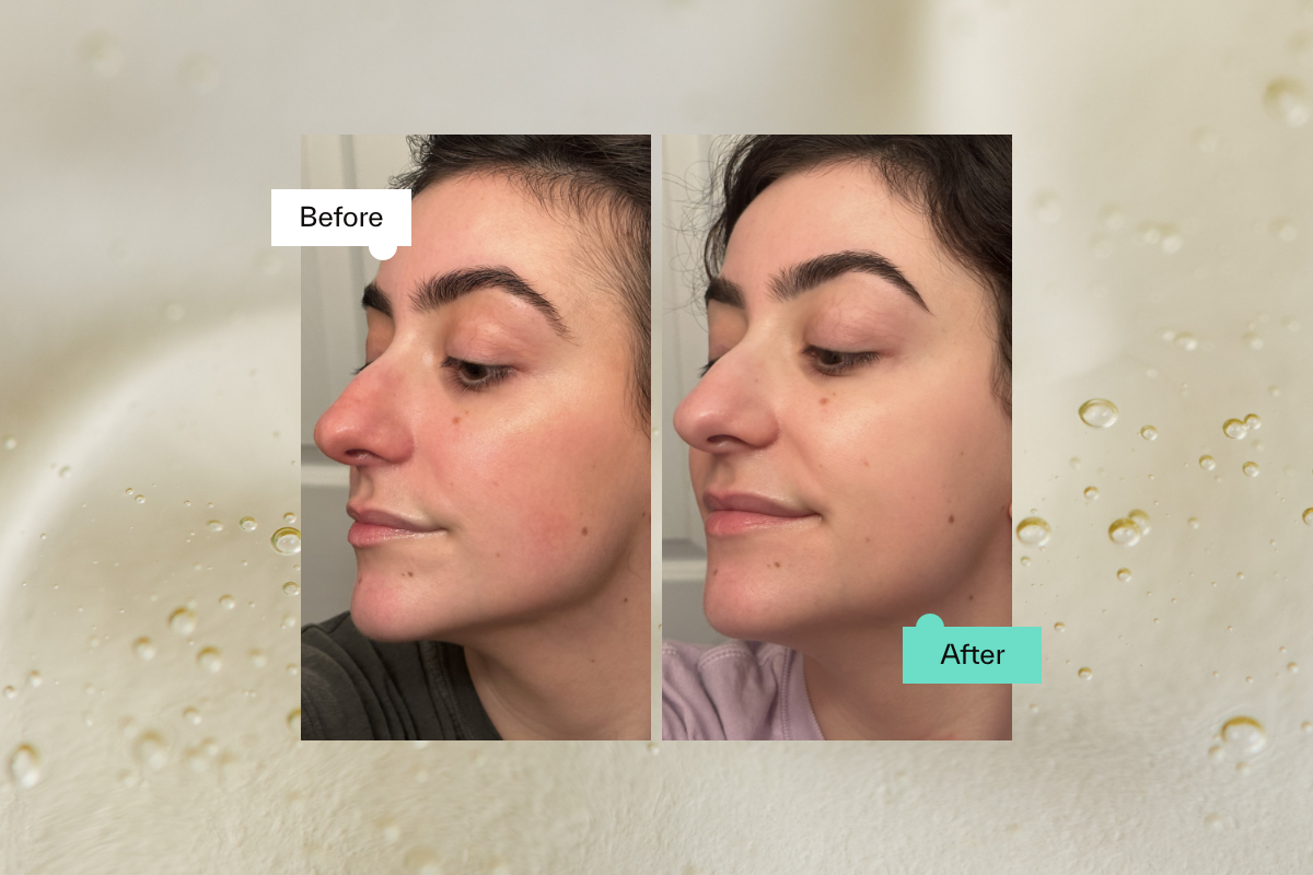 Hyaluronic Acid Before And After