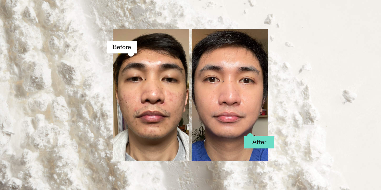 Niacinamide Before And After