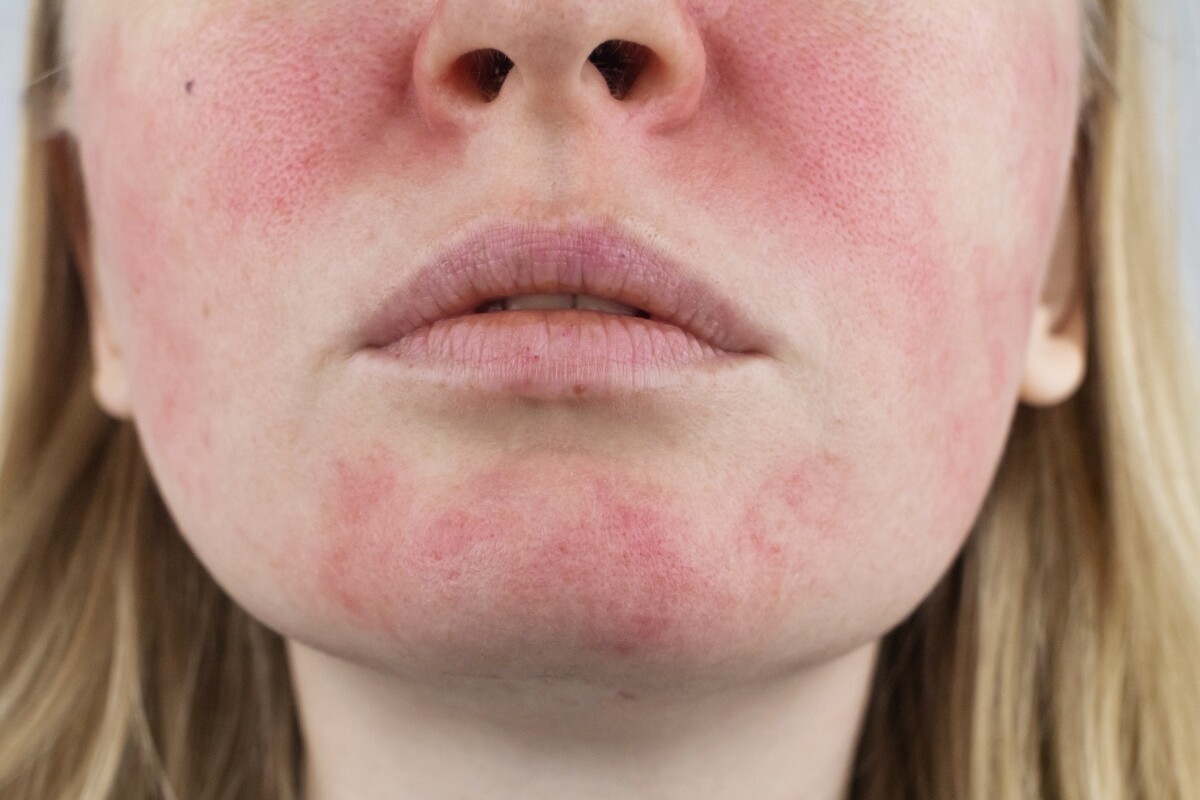 Laser Treatment For Rosacea