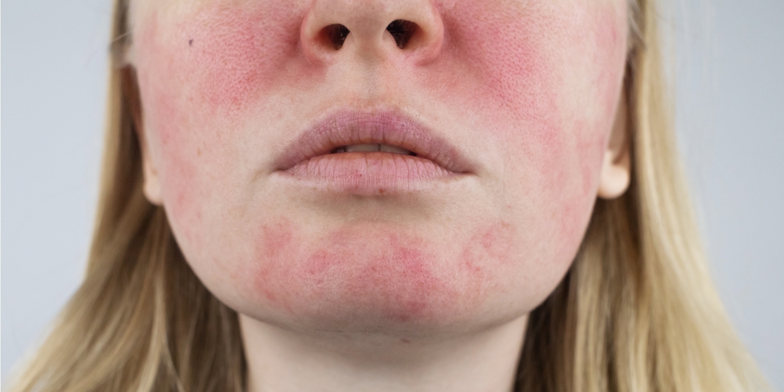 Laser Treatment For Rosacea