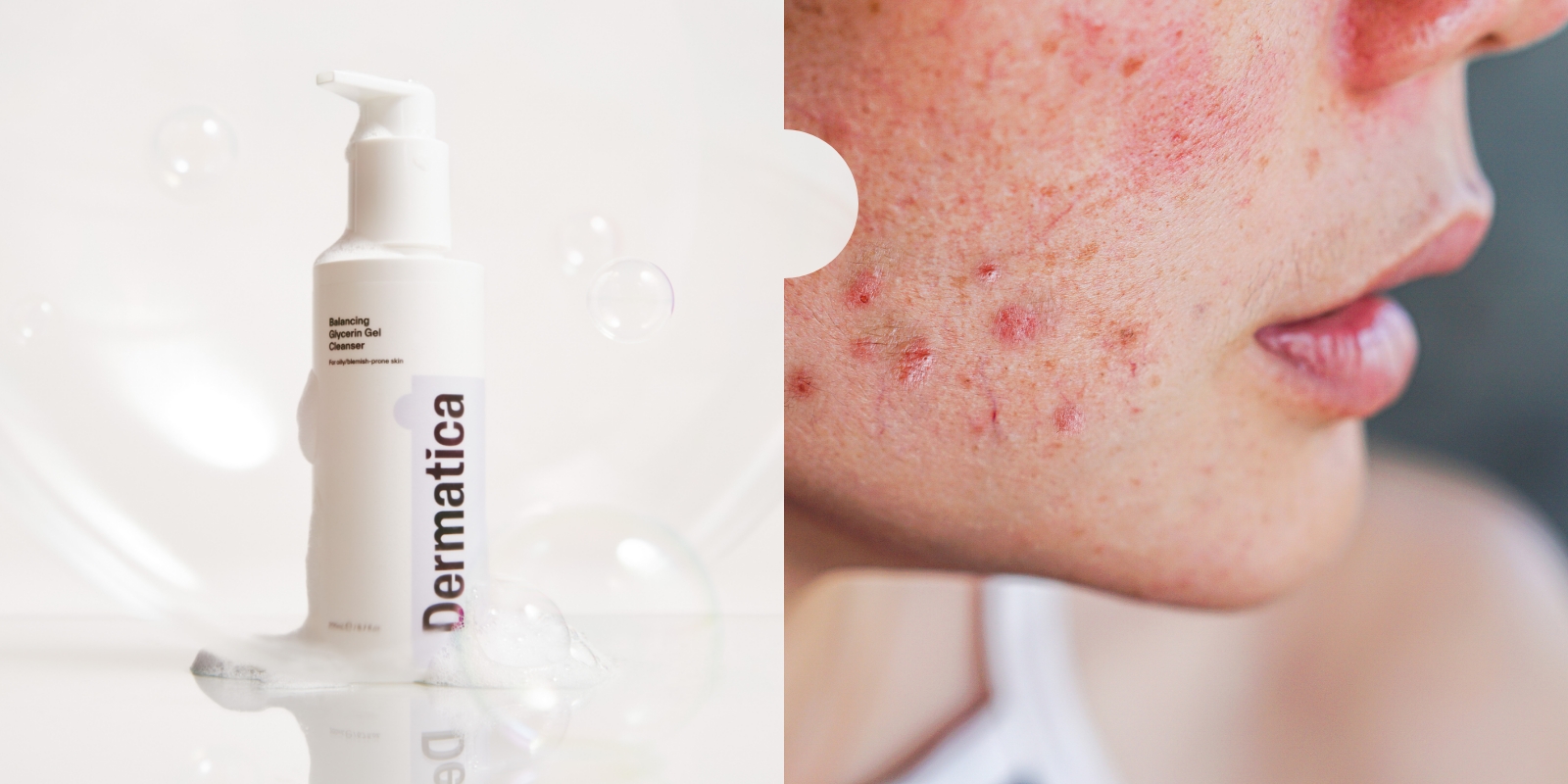 How to get rid of cheek acne overnight