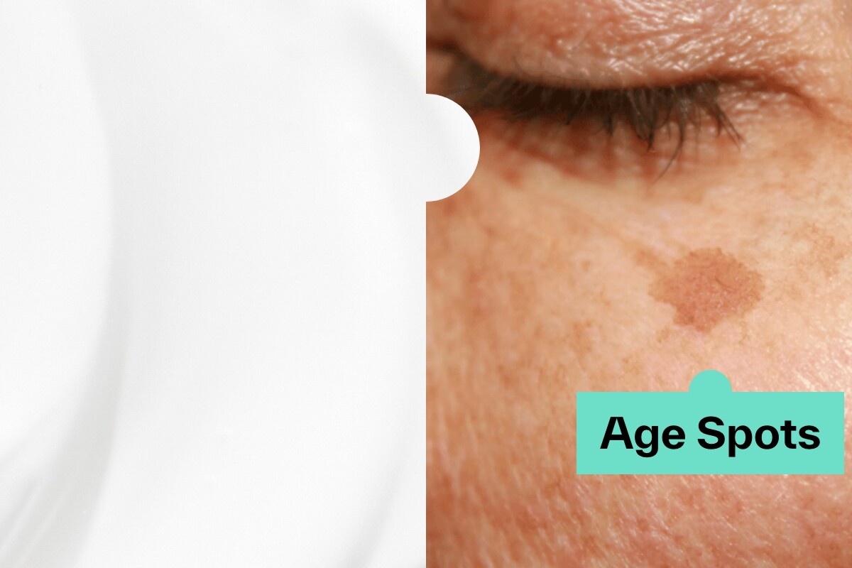 How to remove age spots naturally