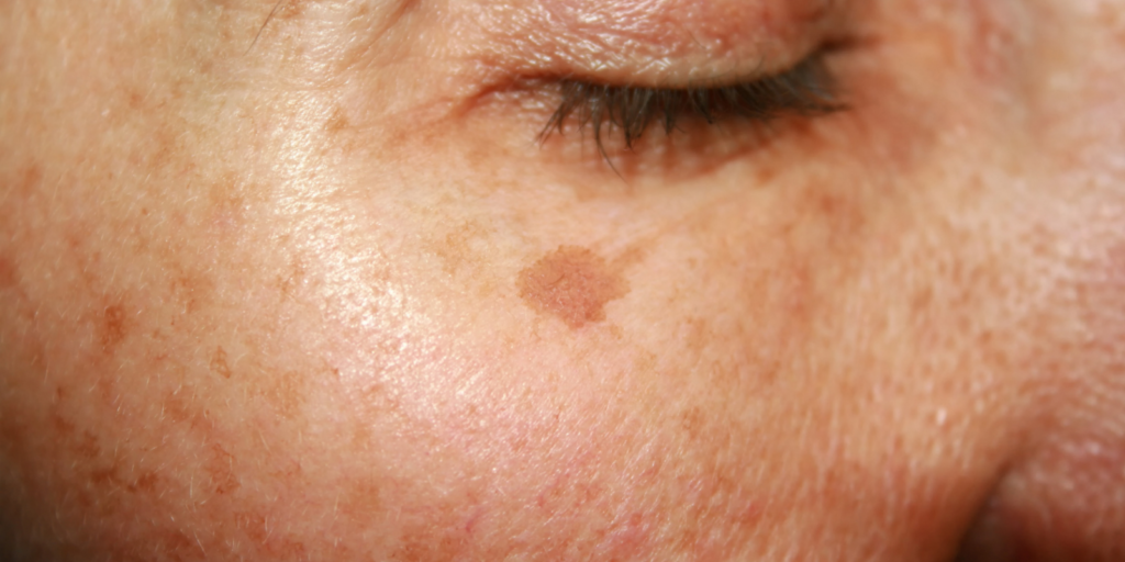 Hyperpigmentation