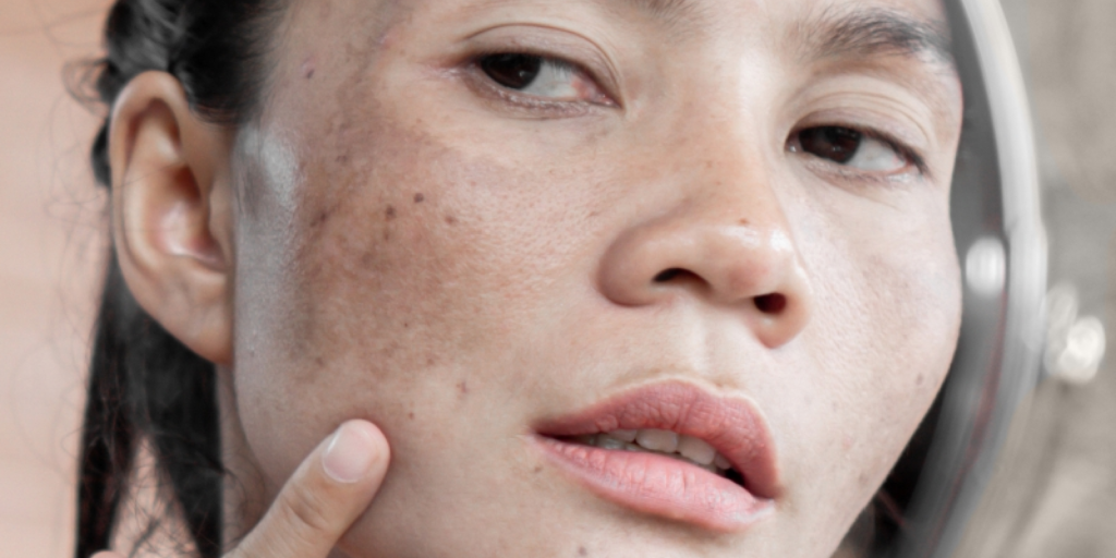 Melasma